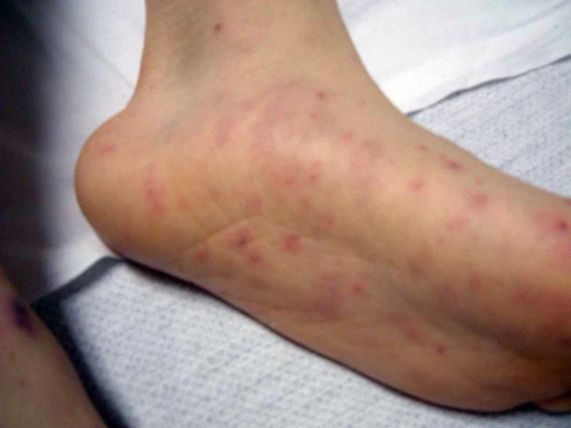 symptoms of meningococcal disease